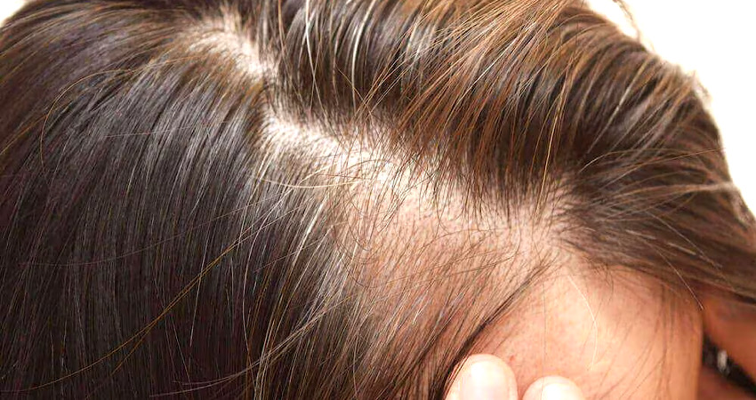 چه کسانی بیشتر در معرض کمبود زینک و ریزش مو هستند؟